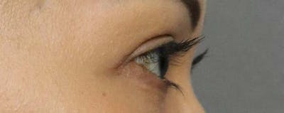 Upper Blepharoplasty Before & After Gallery - Patient 121724325 - Image 2