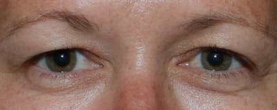 Upper Blepharoplasty Before & After Gallery - Patient 121724326 - Image 1