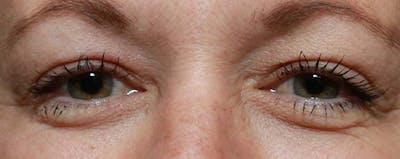 Upper Blepharoplasty Before & After Gallery - Patient 121724326 - Image 2