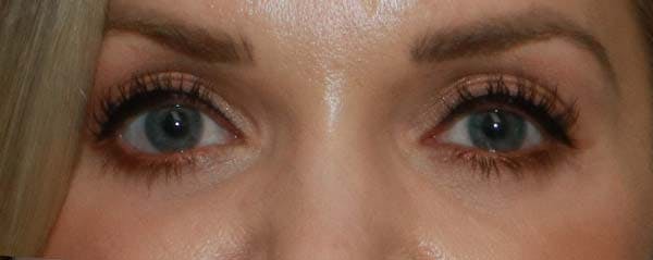 Lower Blepharoplasty Before & After Gallery - Patient 121724332 - Image 2