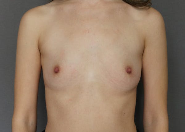 Breast Augmentation Before & After Gallery - Patient 123044975 - Image 1