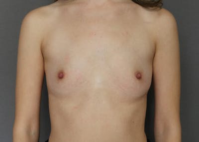Breast Augmentation Before & After Gallery - Patient 123044975 - Image 1