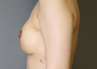 Breast Reconstruction Before & After Gallery - Patient 142468198 - Image 10
