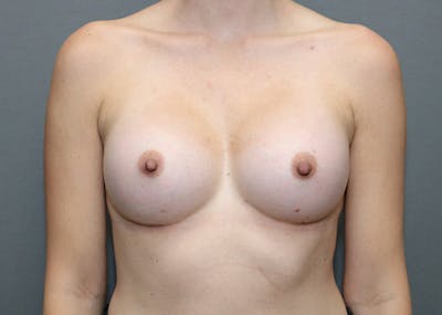 Breast Augmentation Before & After Gallery - Patient 144486402 - Image 2