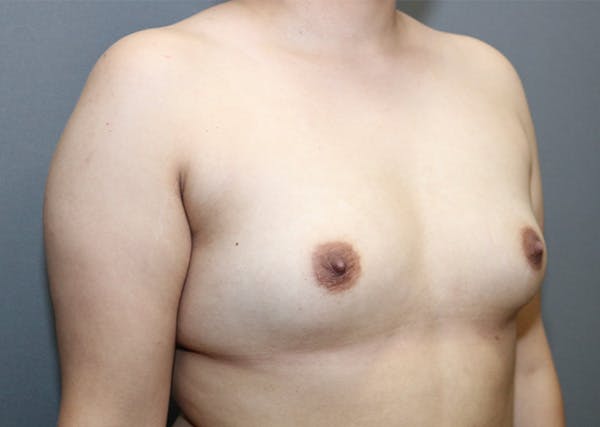 Breast Augmentation Before & After Gallery - Patient 144486432 - Image 3