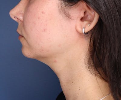 Chin Implant Before & After Gallery - Patient 148679396 - Image 1