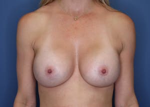 Close up on Before and After Breast Lift in Irvine