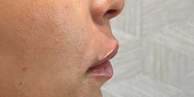 Lip Filler Before & After Gallery - Patient 99750493 - Image 2