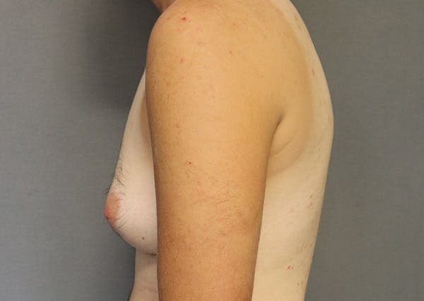 Top Surgery Before & After Gallery - Patient 325435 - Image 5
