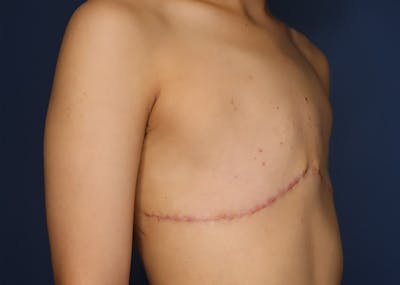 Top Surgery Before & After Gallery - Patient 521832 - Image 4