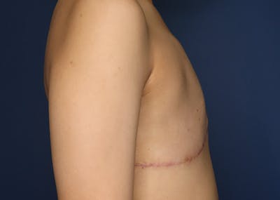 Top Surgery Before & After Gallery - Patient 521832 - Image 6